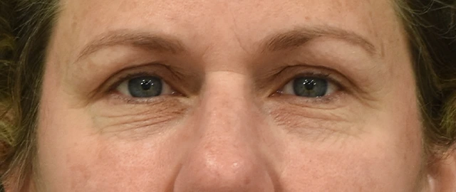 Brow Lift Patient 11 Set 1 Before